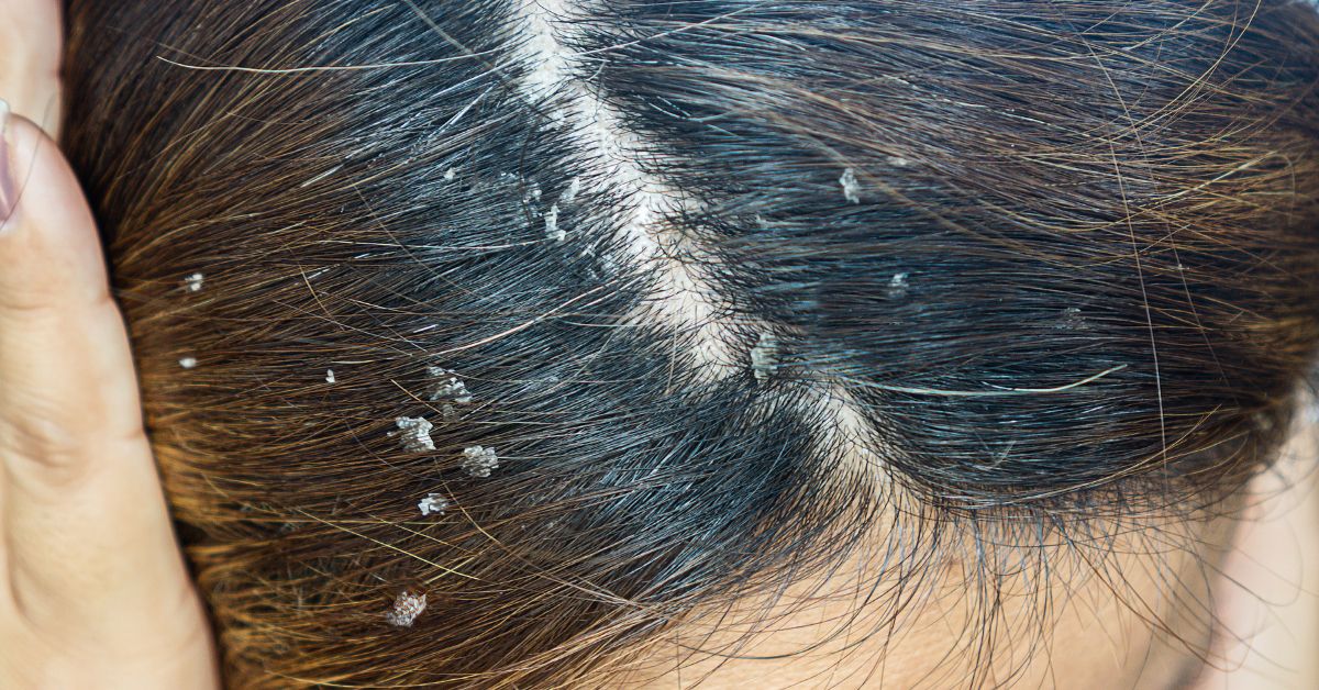Descubra como tratar a dermatite seborreica com sucesso