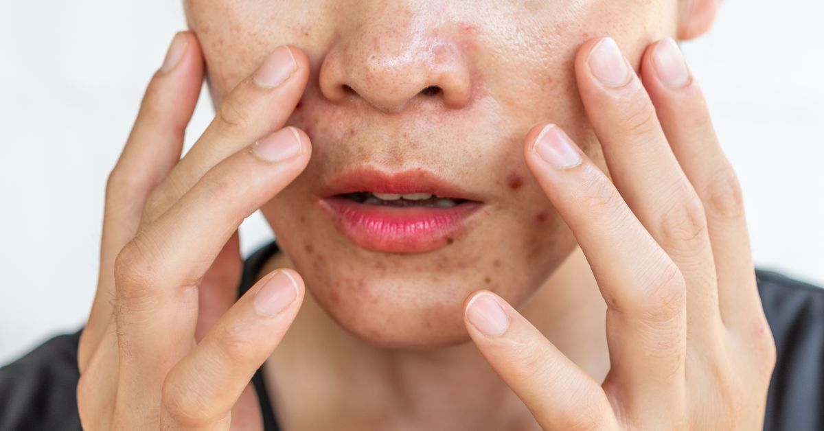 Acne e Pele Oleosa: Entenda as Causas, Prevenção e Tratamentos
