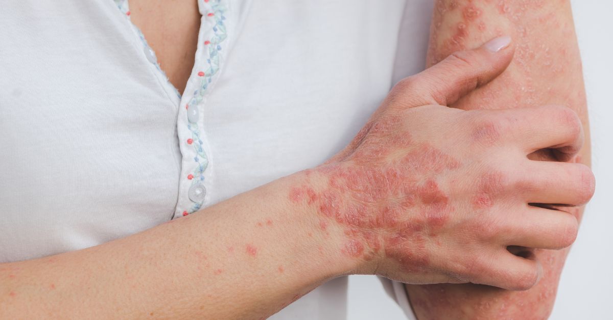 Psoriasis: causas, síntomas y soluciones de tratamiento