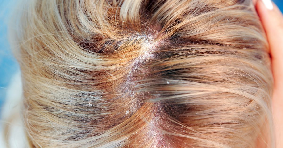 Dermatite Seborreica: Cuidados Essenciais para uma Pele Saudável