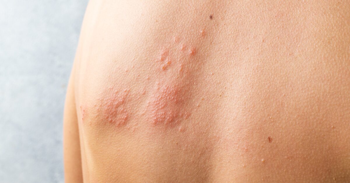 Herpes Zoster: Descubra os Sintomas, Como Prevenir e Soluções Naturais Para Aliviar o Desconforto